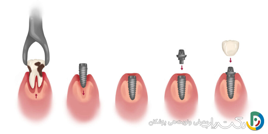 چه خطرات یا مشکلاتی ممکن است در طول فرآیند ایمپلنت دندان پیش آید؟
