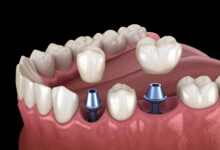 چگونه می توان مناسب بودن برای ایمپلنت دندان را ارزیابی کرد؟