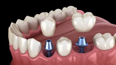 چگونه می توان مناسب بودن برای ایمپلنت دندان را ارزیابی کرد؟