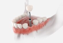 چگونه از ایمپلنت دندان مراقبت کنیم؟