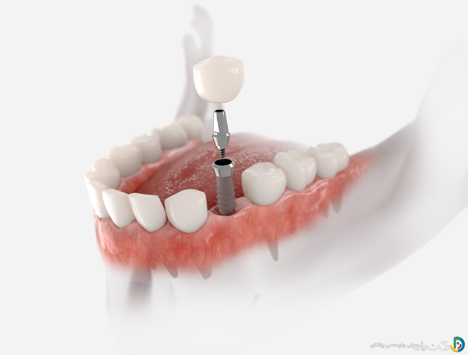 چگونه از ایمپلنت دندان مراقبت کنیم؟