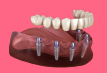چطور می توان بعد از ایمپلنت دندان به سرعت بهبودی یافت؟