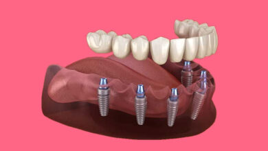 چطور می توان بعد از ایمپلنت دندان به سرعت بهبودی یافت؟