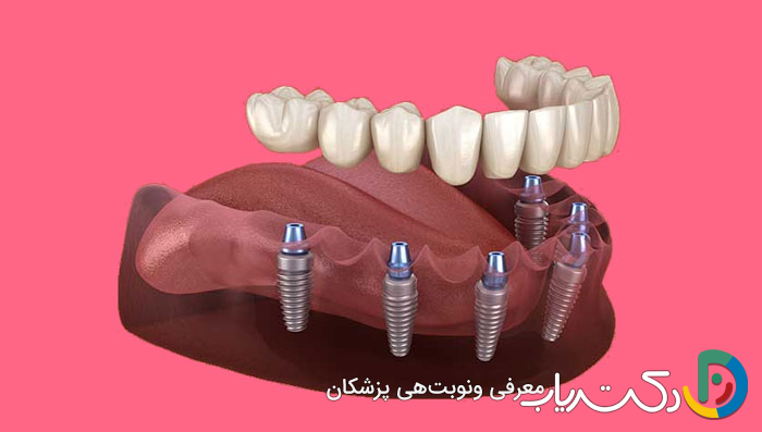 چطور می توان بعد از ایمپلنت دندان به سرعت بهبودی یافت؟