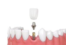 چطور ایمپلنت دندان را تمیز نگه داریم؟