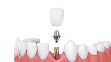 چطور ایمپلنت دندان را تمیز نگه داریم؟