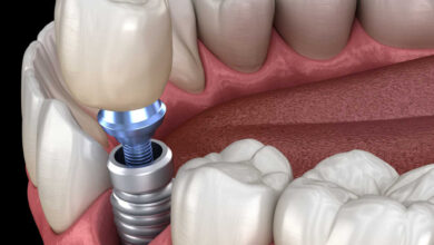 چرا ایمپلنت های دندان دیجیتال آینده دندان پزشکی هستند؟