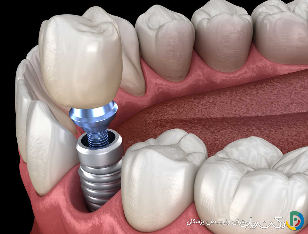 چرا ایمپلنت های دندان دیجیتال آینده دندان پزشکی هستند؟
