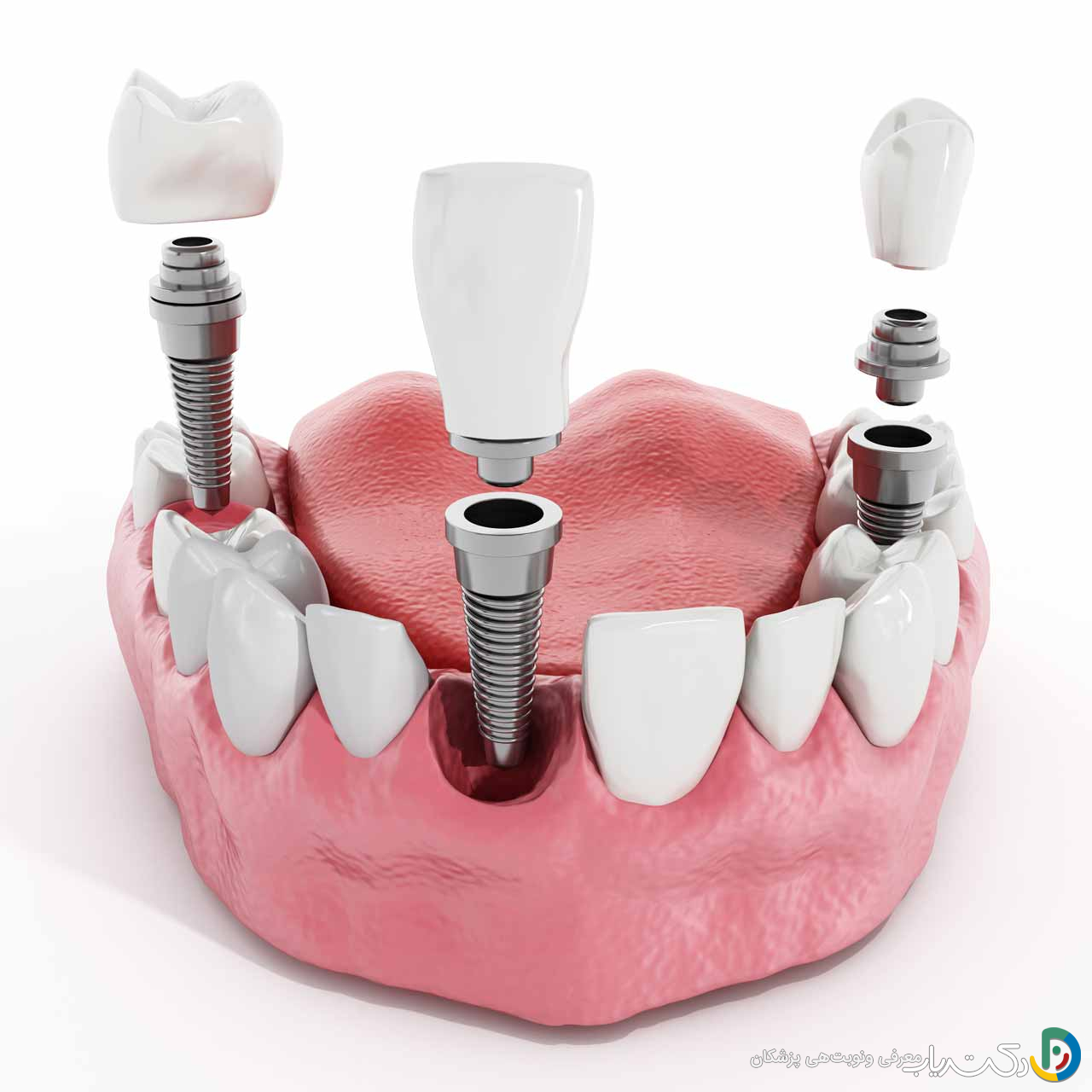 چرا باید از دخانیات و مشروبات الکلی بعد از ایمپلنت دندان اجتناب