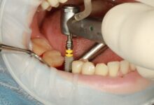 چرا ایمپلنت دندان بهترین گزینه برای ترمیم دندان از دست رفته است؟