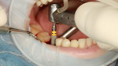 چرا ایمپلنت دندان بهترین گزینه برای ترمیم دندان از دست رفته است؟