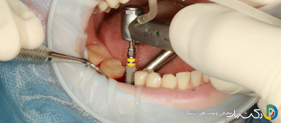 چرا ایمپلنت دندان بهترین گزینه برای ترمیم دندان از دست رفته است؟