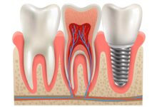 جدیدترین تحقیقات در زمینه ایمپلنت دندان چیست؟