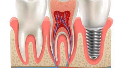 جدیدترین تحقیقات در زمینه ایمپلنت دندان چیست؟