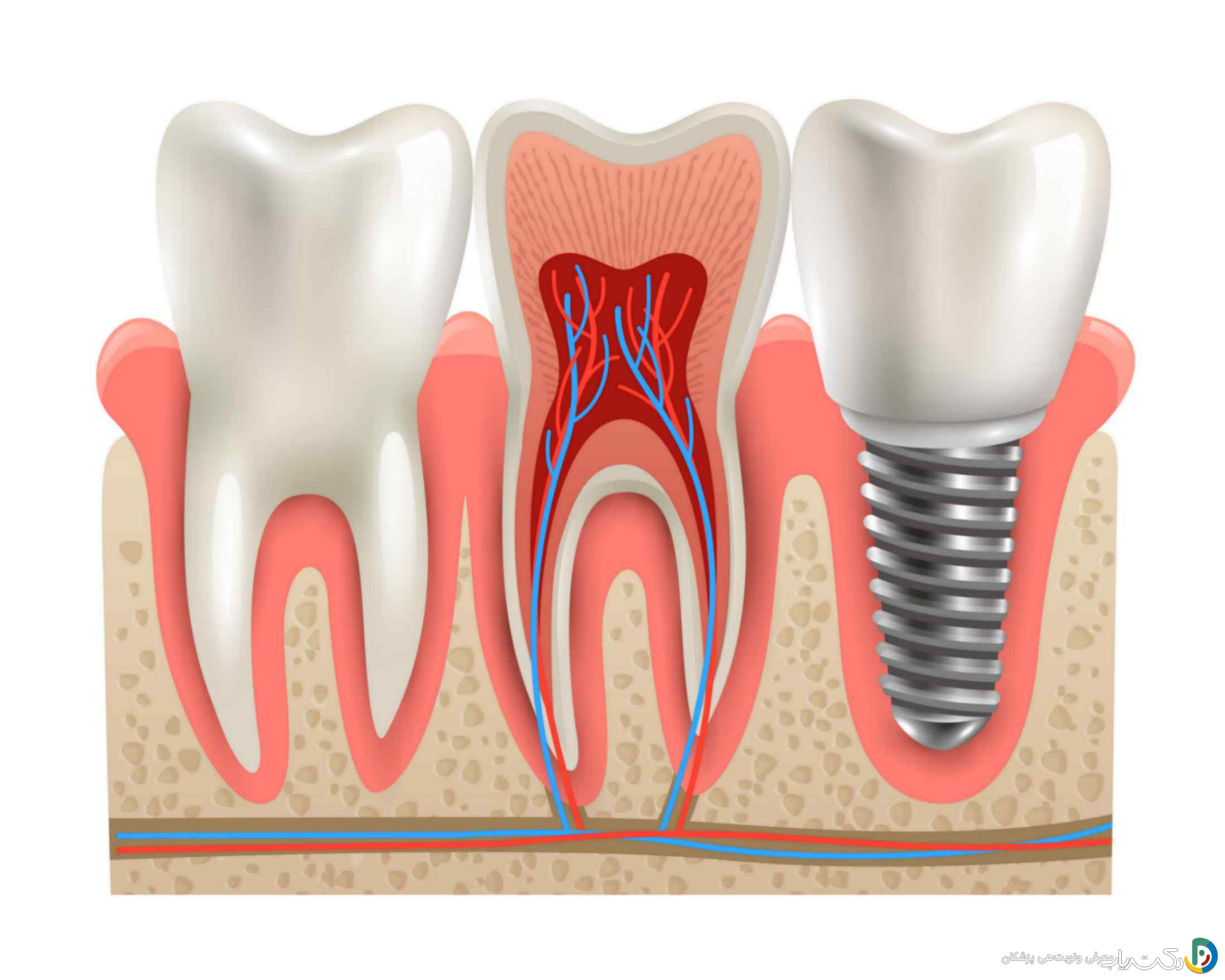 جدیدترین تحقیقات در زمینه ایمپلنت دندان چیست؟
