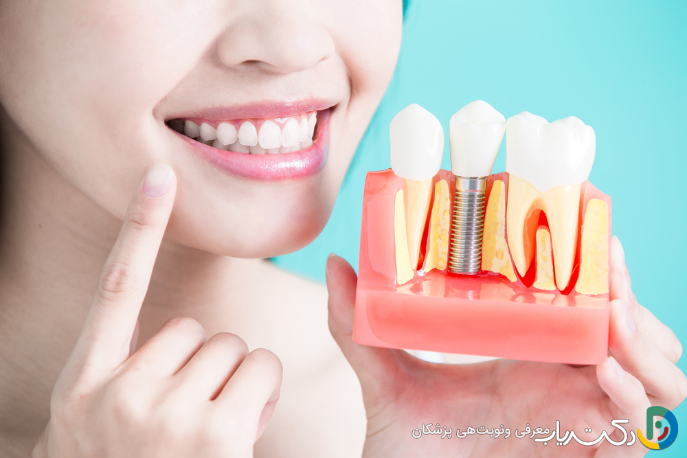 تفاوت هزینه های ایمپلنت دندان در کلینیک های مختلف چیست؟