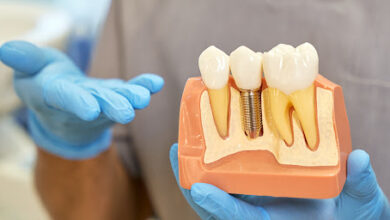 آیا ایمپلنت دندان به مراقبت خاصی نیاز دارد؟