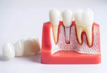 آیا تحقیقات نشان داده اند که ایمپلنت های دندان طول عمر بیشتری دارند؟