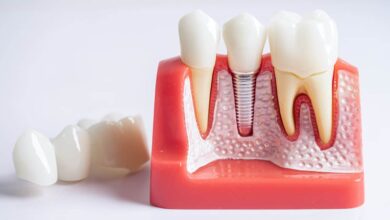 آیا تحقیقات نشان داده اند که ایمپلنت های دندان طول عمر بیشتری دارند؟
