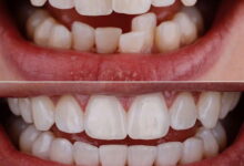 آیا ترمیم دندان برای دندان های کج مناسب است؟