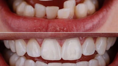 آیا ترمیم دندان برای دندان های کج مناسب است؟