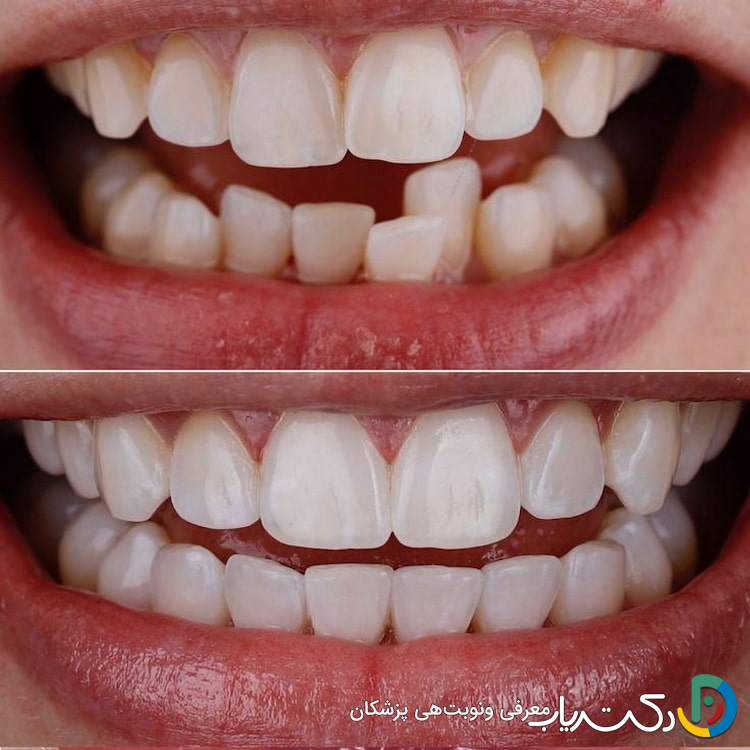 آیا ترمیم دندان برای دندان های کج مناسب است؟