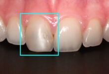 آیا ترمیم دندان برای دندان های جلو مؤثر است؟