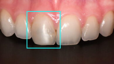 آیا ترمیم دندان برای دندان های جلو مؤثر است؟