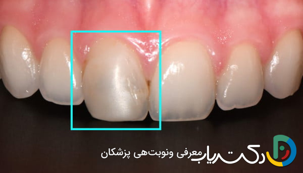 آیا ترمیم دندان برای دندان های جلو مؤثر است؟