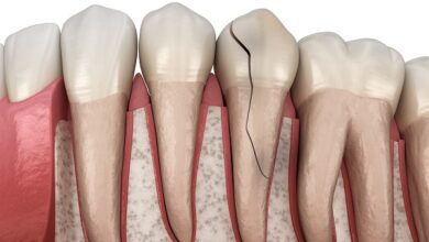 آیا ترمیم دندان در درمان دندان های ترک خورده مؤثر است؟