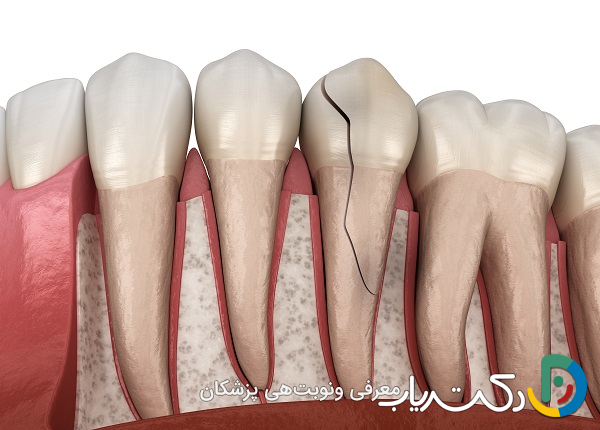آیا ترمیم دندان در درمان دندان های ترک خورده مؤثر است؟