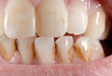 آیا ترمیم دندان ممکن است باعث تغییر رنگ دندان ها شود؟