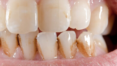 آیا ترمیم دندان ممکن است باعث تغییر رنگ دندان ها شود؟