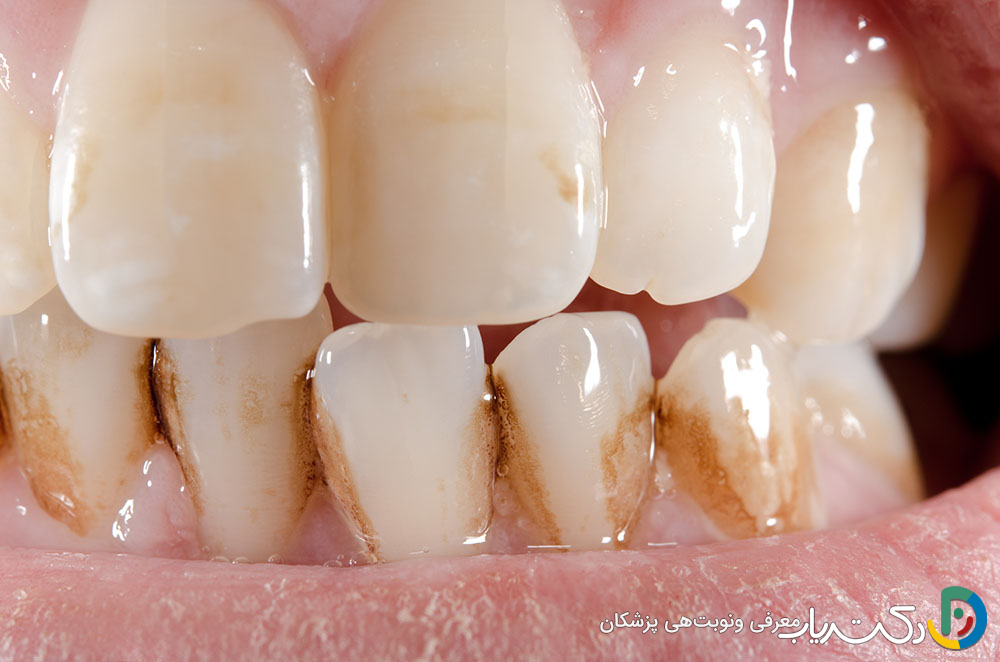 آیا ترمیم دندان ممکن است باعث تغییر رنگ دندان ها شود؟