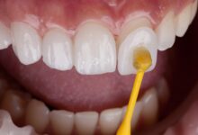 قیمت روکش دندان در تهران (جدول هزینه 1404)