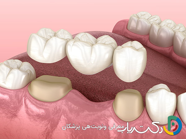 آیا تحقیقات جدید نشان داده اند که روکش دندان مقاوم تر از گذشته است؟