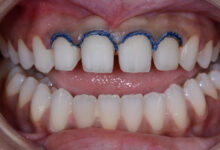 معایب روکش دندان چیست ؟ راهنمای جامع عوارض و محدودیتها