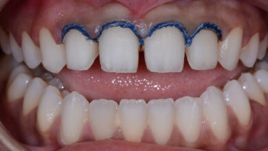 معایب روکش دندان چیست ؟ راهنمای جامع عوارض و محدودیتها