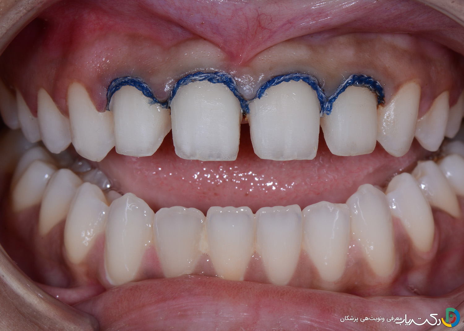 معایب روکش دندان چیست ؟ راهنمای جامع عوارض و محدودیتها