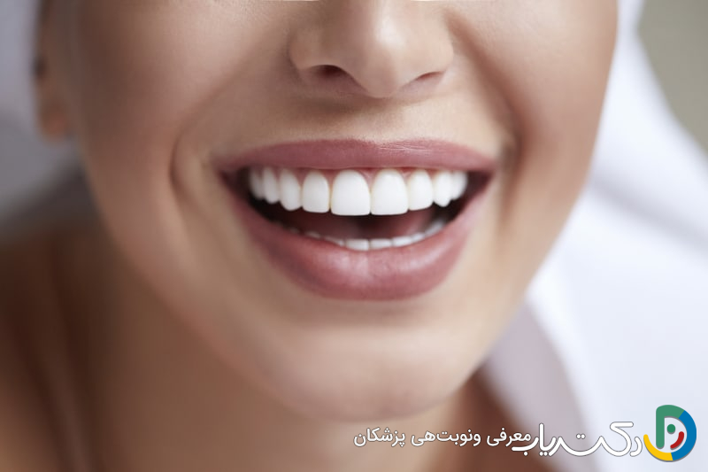 آیا برای بلیچینگ دندان نیاز به مراجعه مکرر است؟