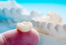 آیا روکش دندان باعث درد یا ناراحتی می شود؟
