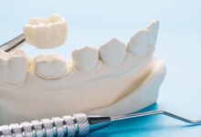 آیا روکش دندان به مرور زمان خراب می شود؟