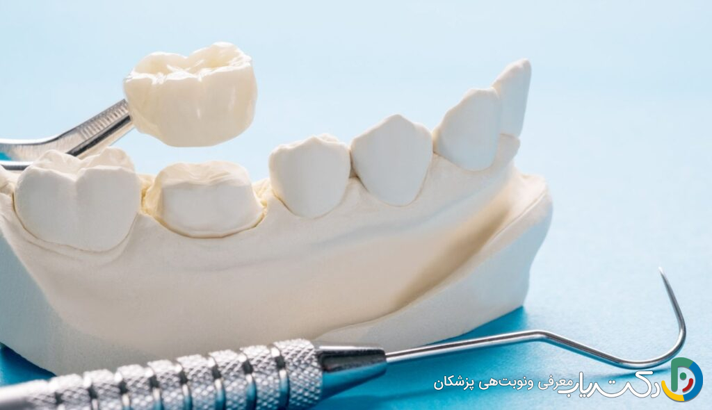 آیا روکش دندان به مرور زمان خراب می شود؟