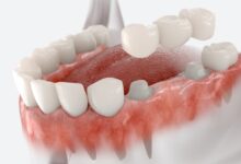 آیا روکش دندان طول عمر زیادی دارد؟