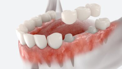 آیا روکش دندان طول عمر زیادی دارد؟