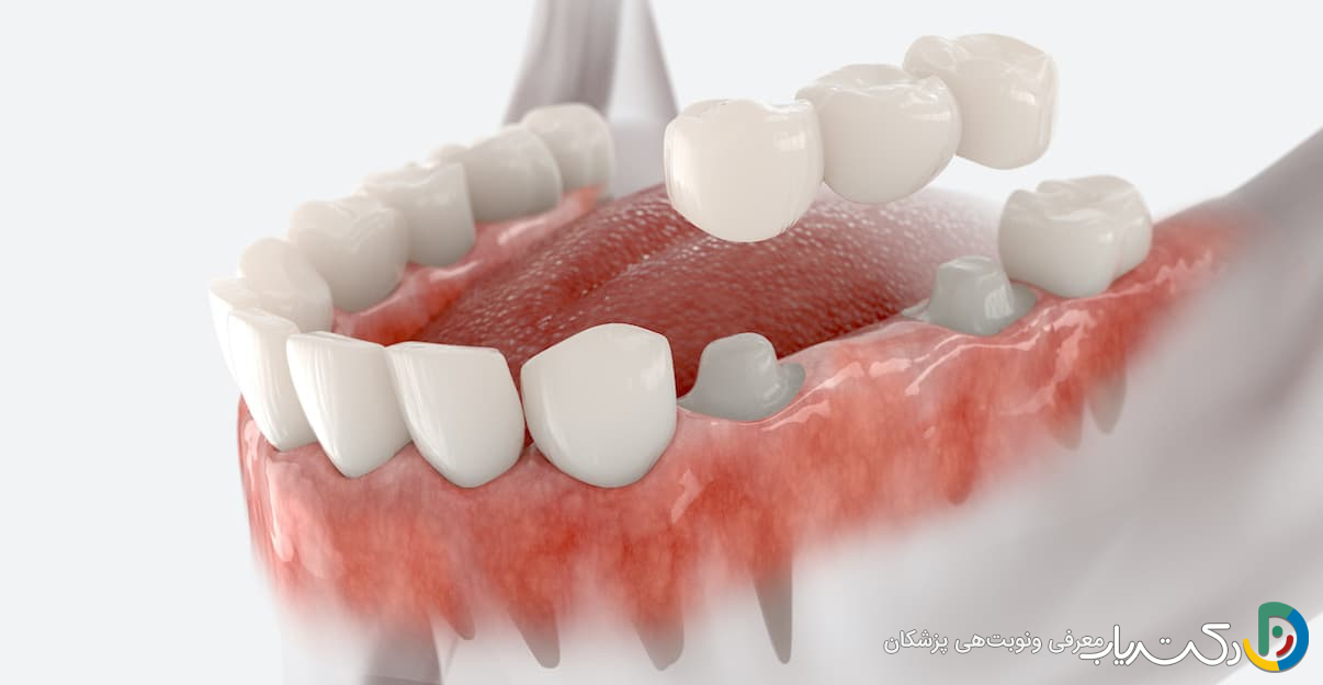 آیا روکش دندان طول عمر زیادی دارد؟