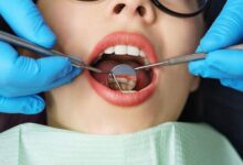 آیا ایمپلنت دندان نیاز به چکاپ دوره ای دارد؟