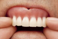 آیا دندان مصنوعی باعث آسیب به لثه ها می شود؟