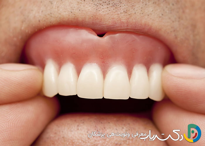 آیا دندان مصنوعی باعث آسیب به لثه ها می شود؟