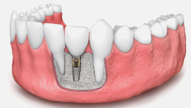 آیا ایمپلنت باعث تحلیل استخوان فک می شود؟